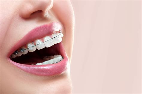 que diferencia hay entre los brackets metalicos y esteticos|Diferencia entre materiales de los brack.